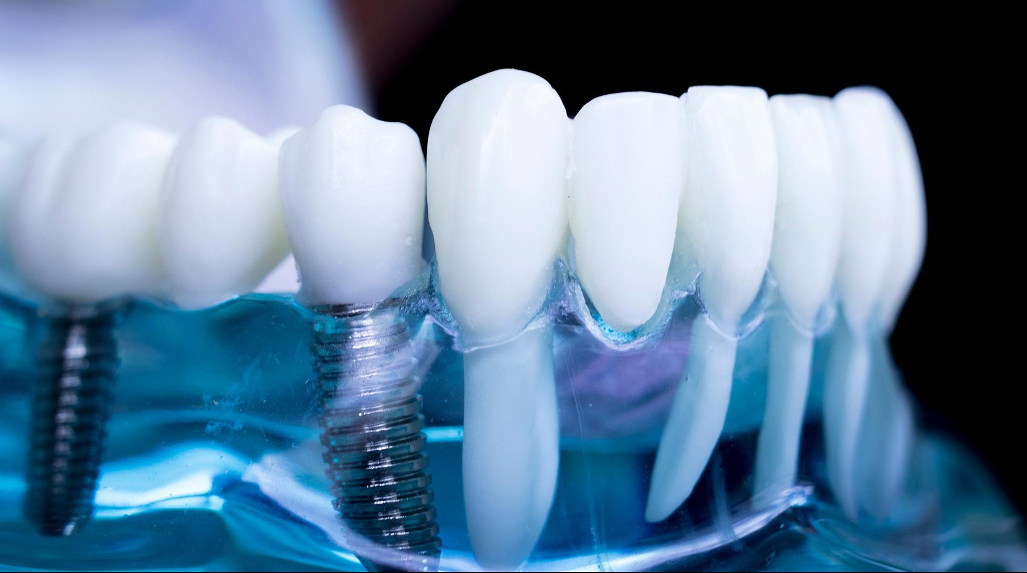 dental implant courses